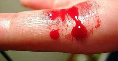 الندوة بمناسبة اليوم العلمي لمرضى النزف الدموي 